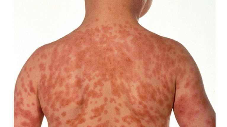 10 Common Rashes on Kids (with photos): Symptoms and Treatment